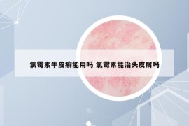 氯霉素牛皮癣能用吗 氯霉素能治头皮屑吗