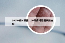 100种癣对照图 100种癣对照图顽固皮癣