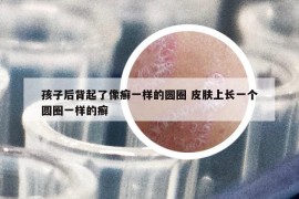 孩子后背起了像癣一样的圆圈 皮肤上长一个圆圈一样的癣