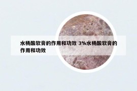 水杨酸软膏的作用和功效 3%水杨酸软膏的作用和功效