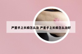 严重手上长癣怎么治 严重手上长癣怎么治好