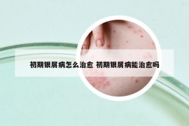 初期银屑病怎么治愈 初期银屑病能治愈吗