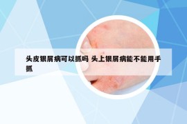 头皮银屑病可以抓吗 头上银屑病能不能用手抓