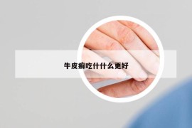 牛皮癣吃什什么更好