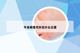 牛皮癣喜欢长在什么位置