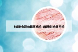 t细胞会影响银屑病吗 t细胞影响怀孕吗