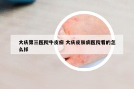 大庆第三医院牛皮癣 大庆皮肤病医院看的怎么样