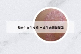 多吃牛肉牛皮癣 一吃牛肉藓就复发