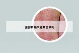 面部白癜风能戴口罩吗