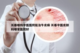 长春哪所中医医院能治牛皮癣 长春中医皮肤科哪家医院好