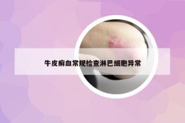 牛皮癣血常规检查淋巴细胞异常