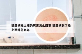 银屑病晚上痒的厉害怎么回事 银屑病到了晚上巨痒怎么办