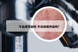 牛批癣传染吗 牛皮肤癣传染吗?