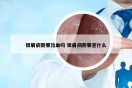 银屑病需要验血吗 银屑病需要查什么