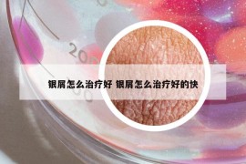 银屑怎么治疗好 银屑怎么治疗好的快