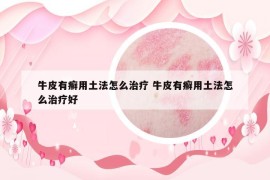 牛皮有癣用土法怎么治疗 牛皮有癣用土法怎么治疗好