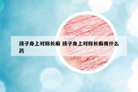 孩子身上对称长癣 孩子身上对称长癣用什么药