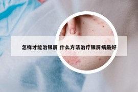 怎样才能治银屑 什么方法治疗银屑病最好