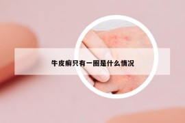 牛皮癣只有一圈是什么情况