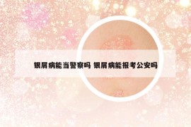 银屑病能当警察吗 银屑病能报考公安吗