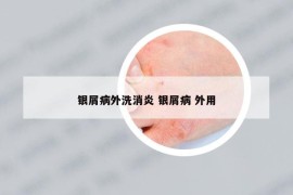 银屑病外洗消炎 银屑病 外用