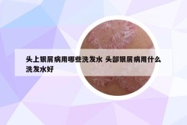 头上银屑病用哪些洗发水 头部银屑病用什么洗发水好