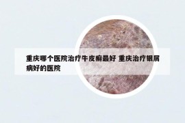 重庆哪个医院治疗牛皮癣最好 重庆治疗银屑病好的医院