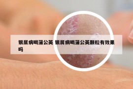 银屑病喝蒲公英 银屑病喝蒲公英颗粒有效果吗