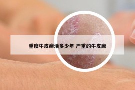 重度牛皮癣活多少年 严重的牛皮廨