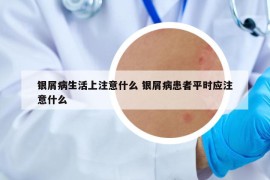 银屑病生活上注意什么 银屑病患者平时应注意什么