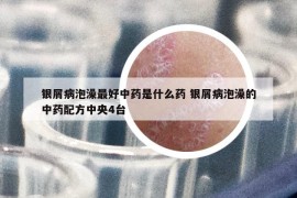 银屑病泡澡最好中药是什么药 银屑病泡澡的中药配方中央4台