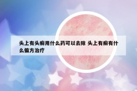 头上有头癣用什么药可以去除 头上有癣有什么偏方治疗