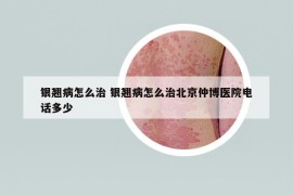 银翘病怎么治 银翘病怎么治北京仲博医院电话多少