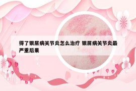 得了银屑病关节炎怎么治疗 银屑病关节炎最严重后果