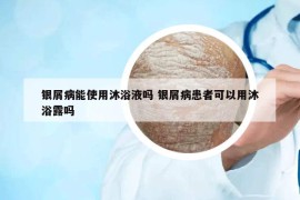 银屑病能使用沐浴液吗 银屑病患者可以用沐浴露吗