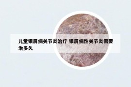 儿童银屑病关节炎治疗 银屑病性关节炎需要治多久