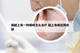 我腿上有一种癣痒怎么治疗 腿上有癣还痒皮肤