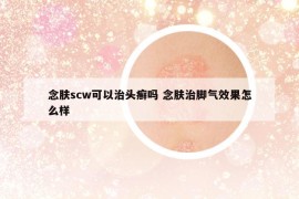 念肤scw可以治头癣吗 念肤治脚气效果怎么样