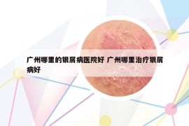 广州哪里的银屑病医院好 广州哪里治疗银屑病好