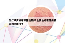 治疗银屑病哪家医院最好 全国治疗银屑病最好的医院排名