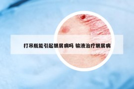 打吊瓶能引起银屑病吗 输液治疗银屑病