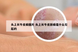 头上长牛皮癣图片 头上长牛皮肤癣是什么引起的