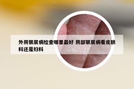 外阴银屑病检查哪里最好 阴部银屑病看皮肤科还是妇科