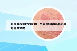 银屑病不能吃的食物一览表 银屑病具体不能吃哪些食物