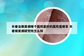 长春治银屑病哪个医院最好的医院是哪家 长春银屑病研究所怎么样