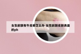 女生前额有牛皮癣怎么办 女性前额皮肤表面的ph