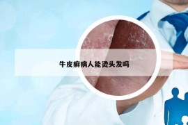 牛皮癣病人能烫头发吗