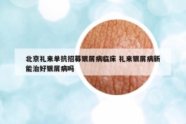 北京礼来单抗招募银屑病临床 礼来银屑病新能治好银屑病吗