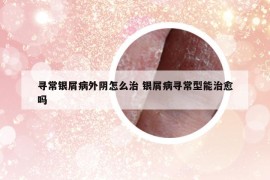 寻常银屑病外阴怎么治 银屑病寻常型能治愈吗