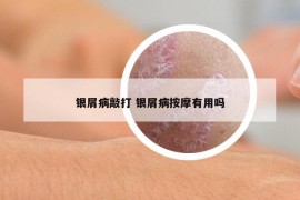 银屑病敲打 银屑病按摩有用吗